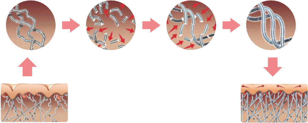 exilis ultra 360 process