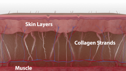 how thermage FLX works (step 1)