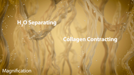how thermage FLX works (step 3)