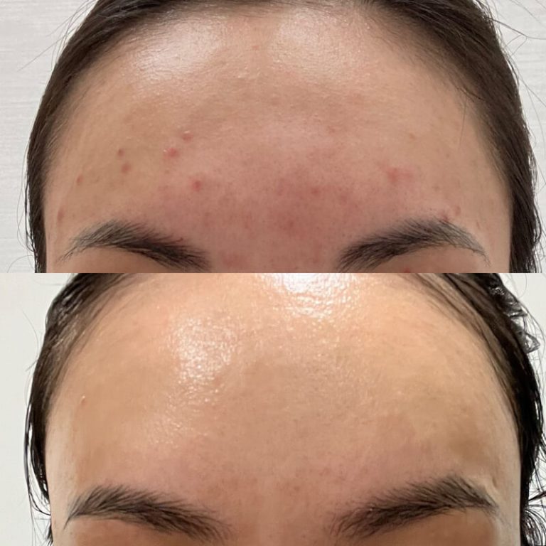 Customer Real Case Sharing Acne Problems